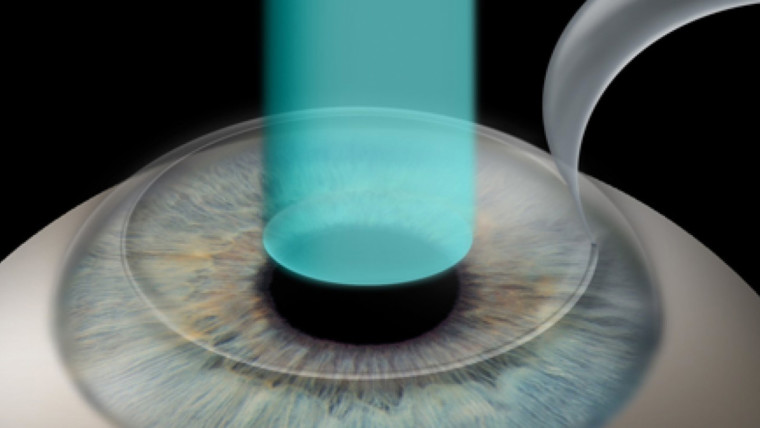 Как узнать, являетесь ли Вы хорошим кандидатом для лазерной рефракционной хирургии глаза?