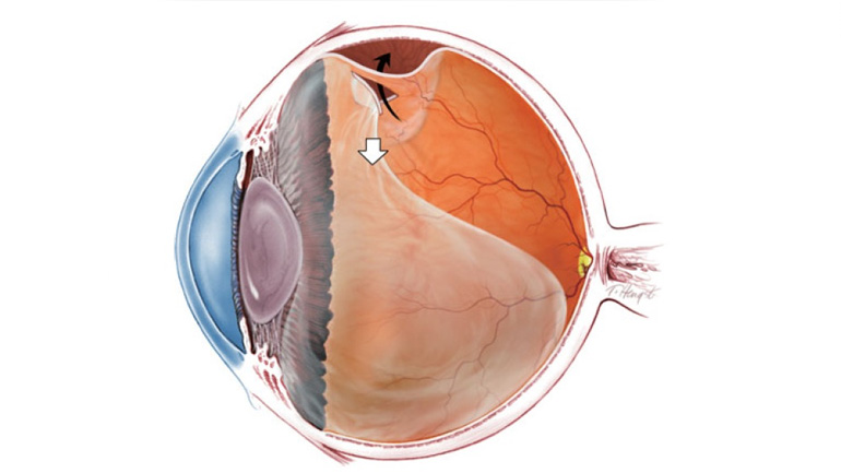 postoperatorio de desprendimiento de retina