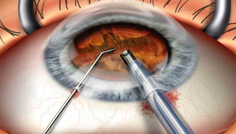 Ухудшение зрения после удаления катаракты