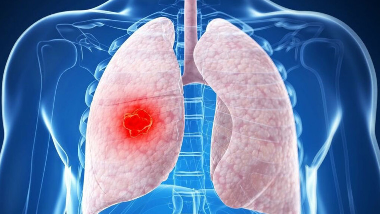 Cómo detectar y tratar el cáncer de pulmón