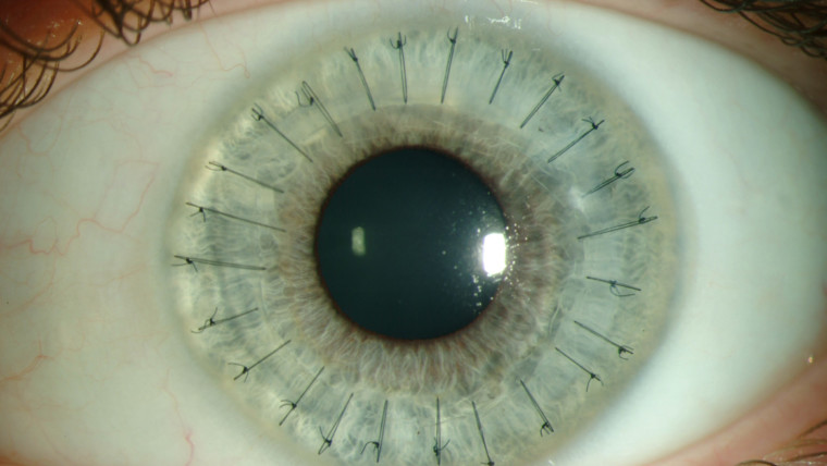 Наиболее частые патологии роговицы глаза: пересадка роговицы