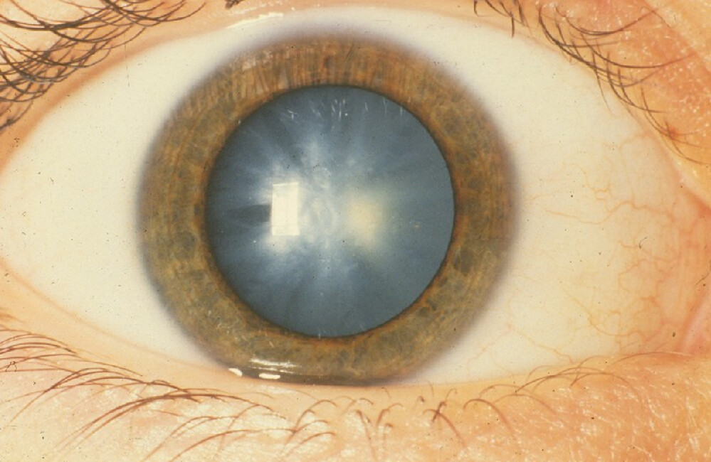 Врожденная катаракта у 40- летнего мужчины