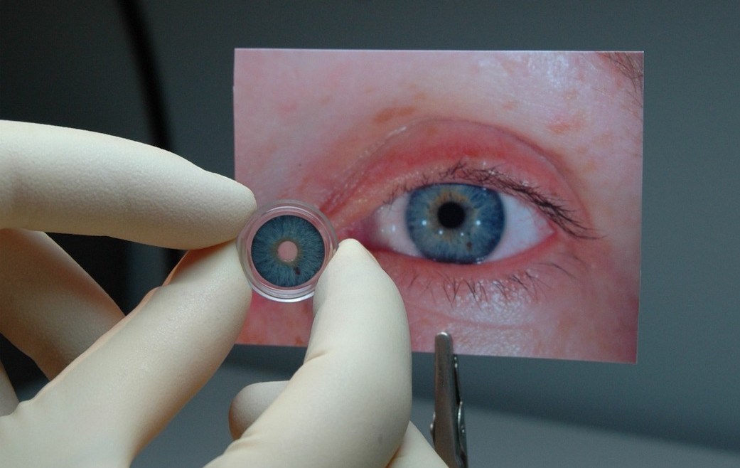 Implante de iris artificial