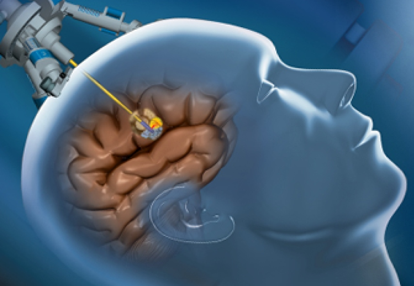 Что такое резекция опухоли головного мозга?